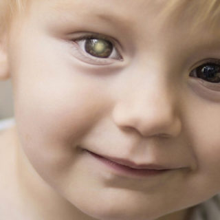 Retinoblasztómás kisfiú, fehéren csillanó szemmel (a knowtheglow.org fotója)