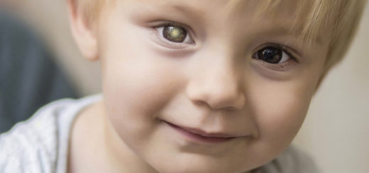 Retinoblasztómás kisfiú, fehéren csillanó szemmel (a knowtheglow.org fotója)